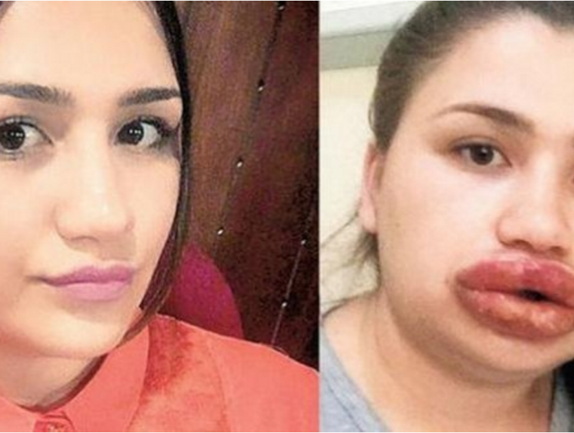 Turkish beauty: after plastic surgery, the girl could not open her mouth - beauty, Fashion, Lips, Operation