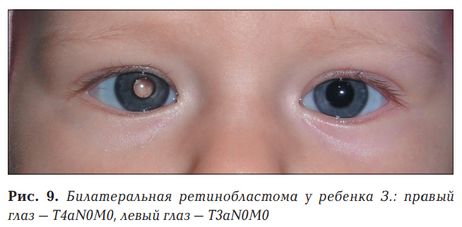 На фото один зрачок светится у ребенка На фото один зрачок светится у ребенка
