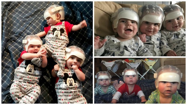 One in 500 trillion chance: why are these triplets wearing special helmets? - Children, Parents, Chance, Help, Health, Triplets, Helmet, Disease, Longpost