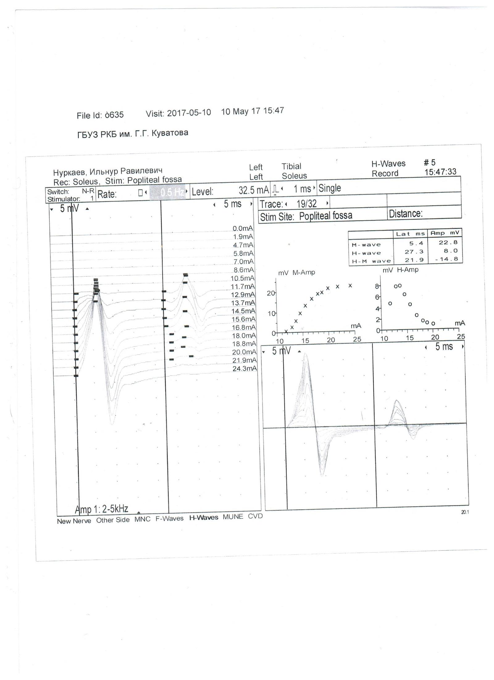 Undertook to study the direction of electroneuromyography and need help with decoding - My, , , Neurology, Neurosurgery, The medicine, Longpost