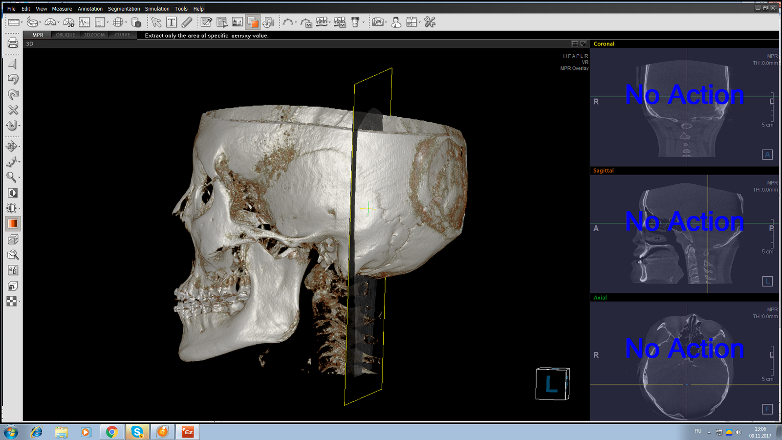 My poor little head, or rather skull. No brains are observed. Computed tomography of the upper and lower jaws + maxillary sinuses. - Tomography, Anatomy, Person, Scull, My