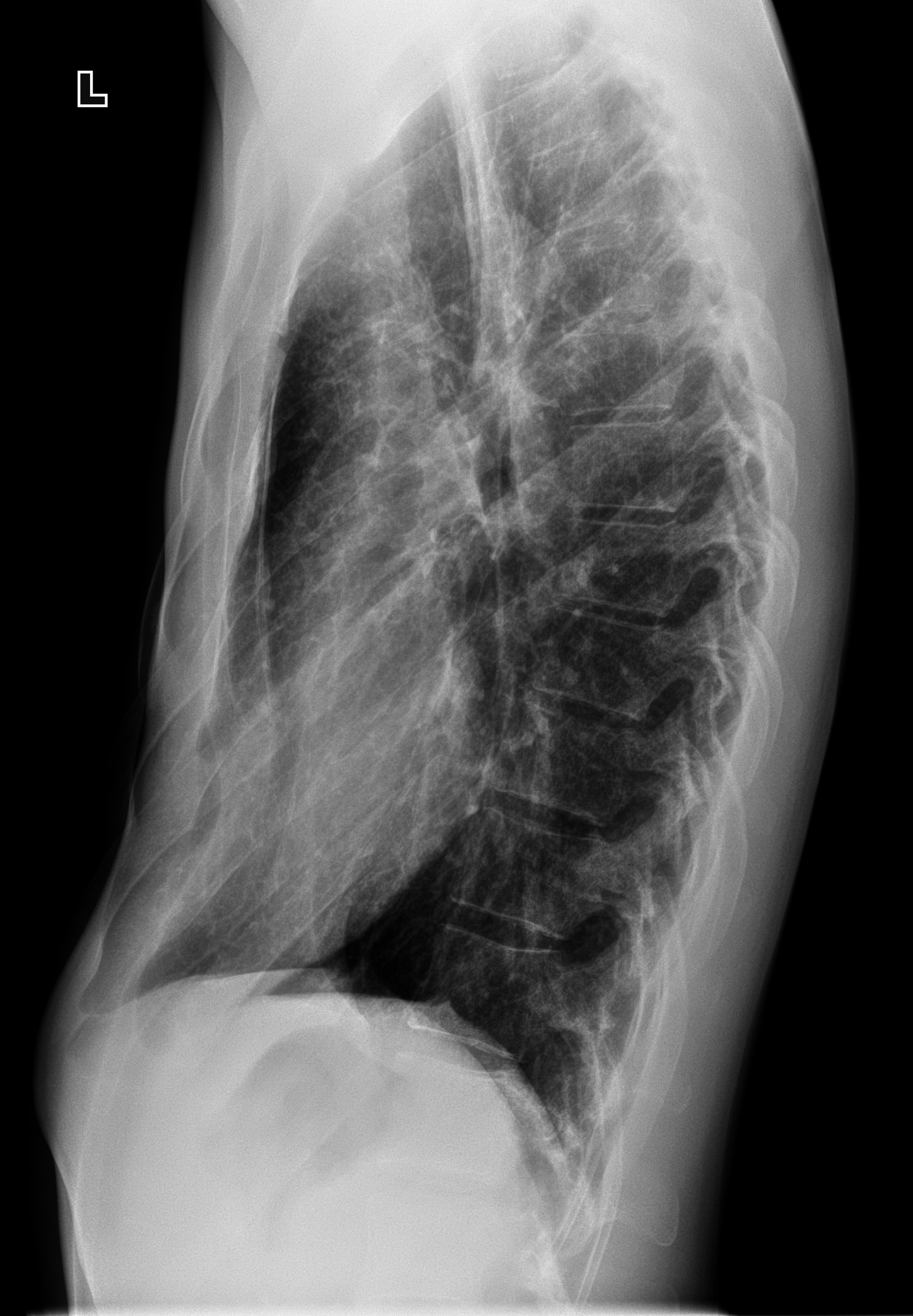 From the life of a radiologist. Part 15 - My, X-ray, The medicine, Fracture, Necrosis, Stump, Longpost