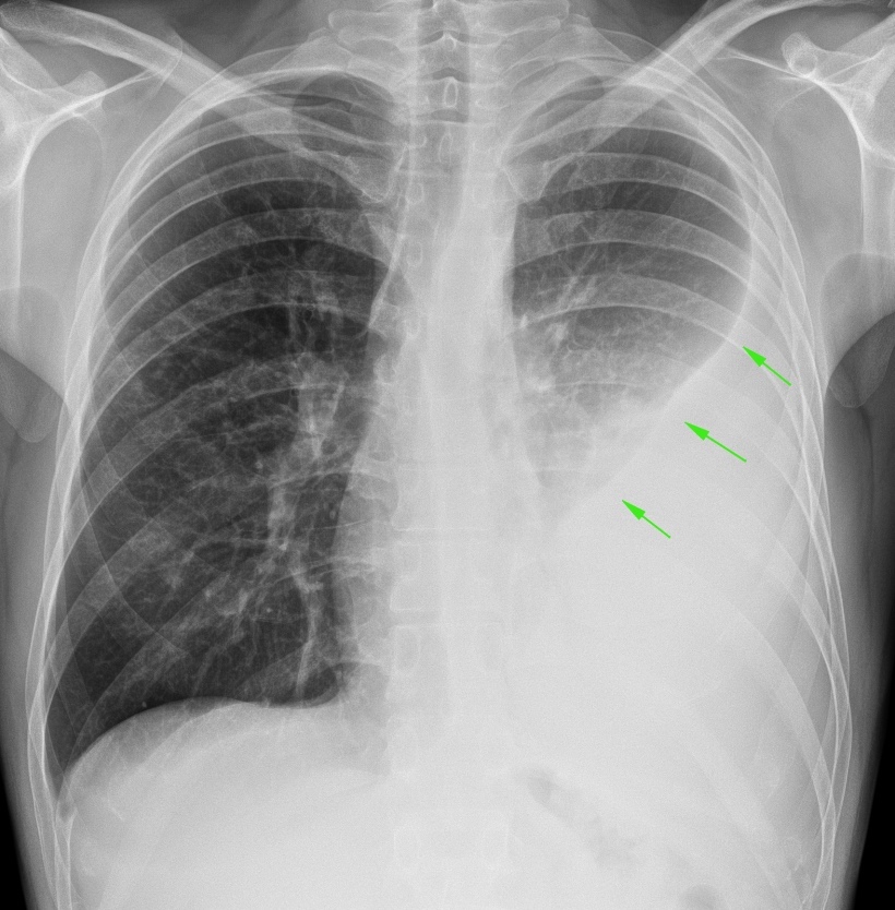 From the life of a radiologist. Part 16 - My, X-ray, The medicine, Fracture, Diverticulitis, Pneumothorax, Hydrothorax, Scoliosis, Longpost