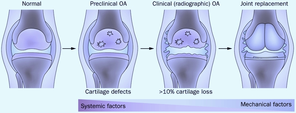 About arthrosis: myths and legends. - My, The medicine, Health, Longpost