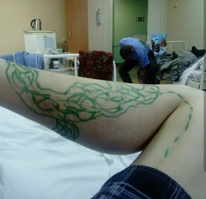 Varicose veins - My, Story, Story, Disease, Longpost, Text, Varicose veins, Operation, Hospital