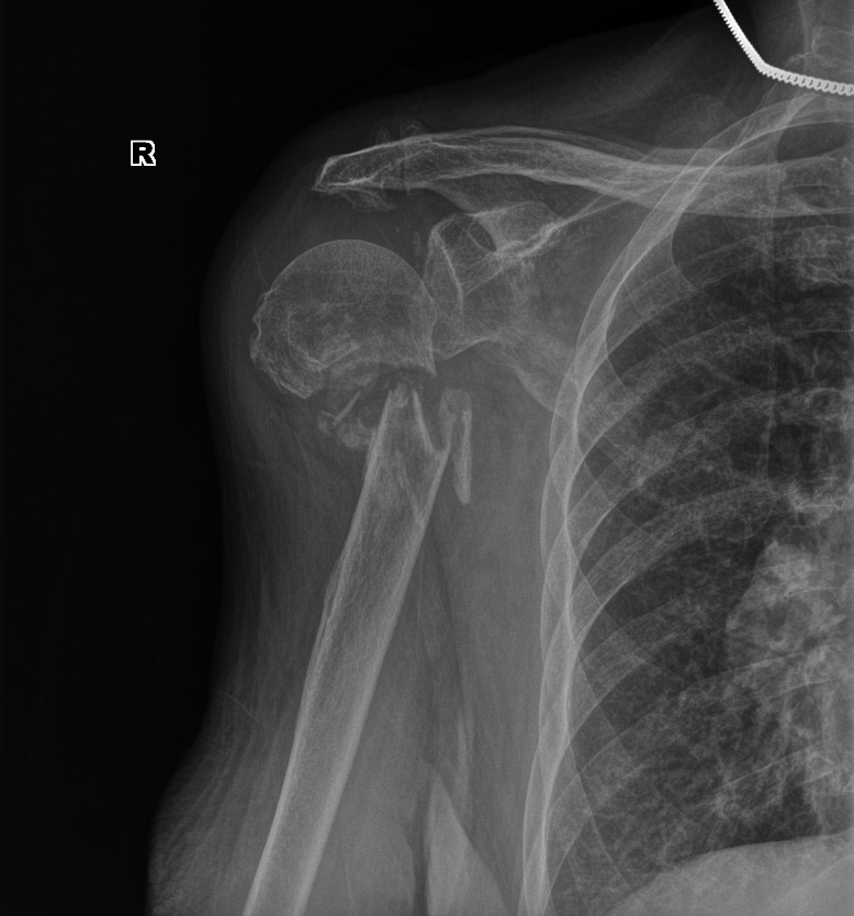 From the life of a radiologist. Part 22. Traumatic. - My, X-ray, The medicine, Longpost