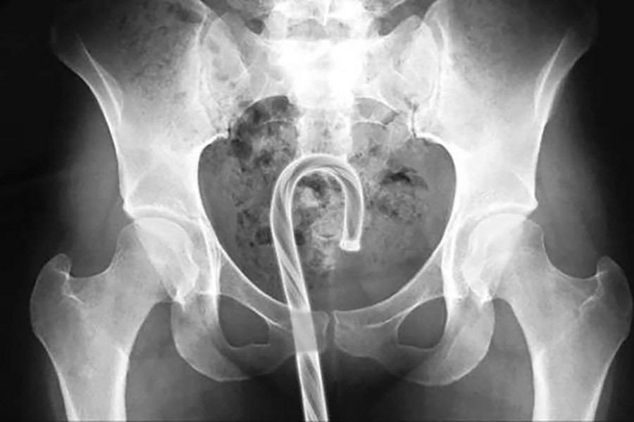 They put anything in themselves!!! - NSFW, X-ray, Perverts, Trash, The medicine, Items, Longpost, Foreign body