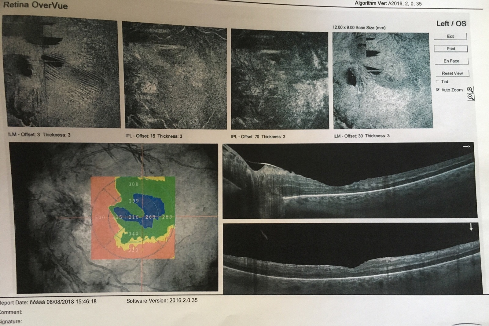 Ophthalmologists, surgeons (diabetologists) - need your opinion, please - My, Eyes, Surgery, Diabetes, Help, Operation, Longpost