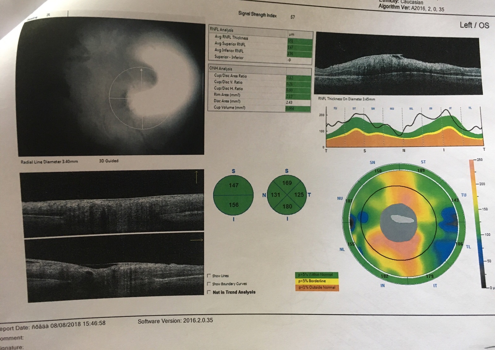 Ophthalmologists, surgeons (diabetologists) - need your opinion, please - My, Eyes, Surgery, Diabetes, Help, Operation, Longpost