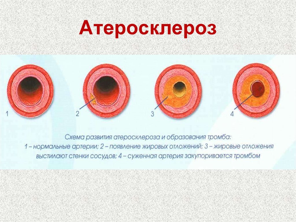 Характерный симптом при атеросклерозе артерий тест. Стадии формирования атеросклеротической бляшки. Атеросклероз схема.