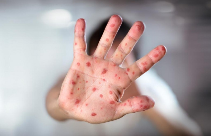 Measles enters apartments in the most unusual ways - Measles, Disease