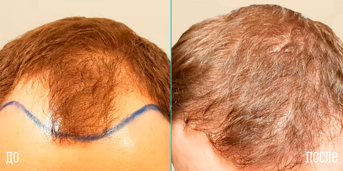 Выпадают волосы после пересадки. Смещение волос. Трансплантация волос по месяцам. Мужчины после пересадки волос.