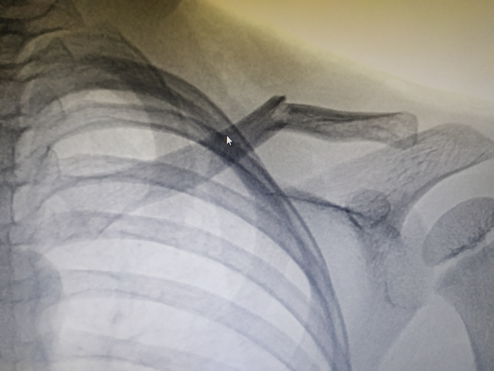 Did the child break his arm? - My, Children, Fracture, The patients, Longpost