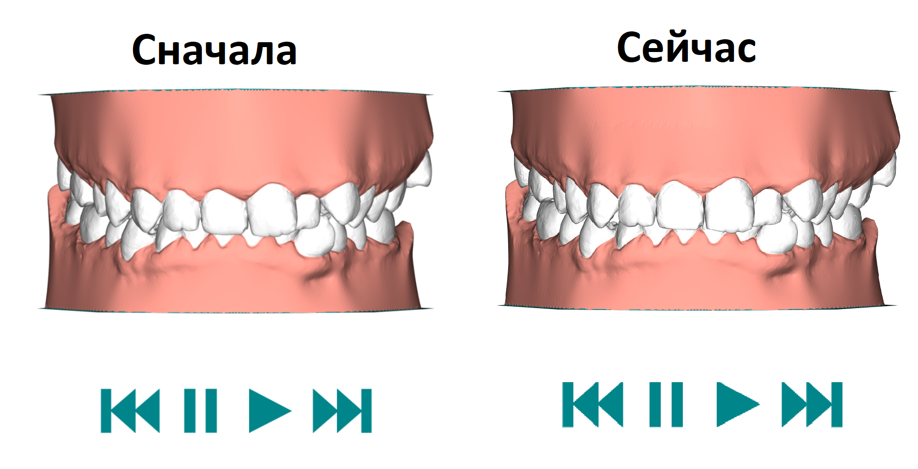 Сейчас сначала. Стенд с прикусами. Элайнеры после 2 недель носки.