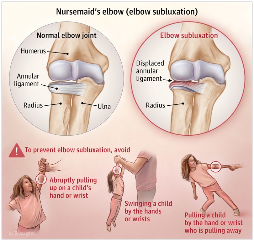 Elbow subluxation in children (nurse's elbow) - My, Orthopedics, Injury, Traumatology, Children, Dislocation, The medicine, Longpost, Video