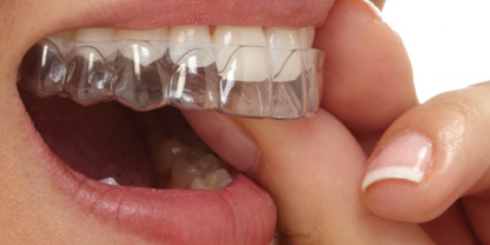 A look at aligner trays from the other side of the barricades - Part 1 - My, Dentistry, Bite correction, Longpost