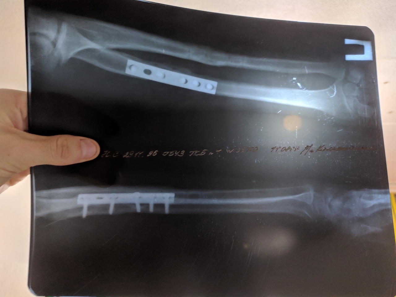 Defect after a fracture of the right forearm - Broken arm, Doctors need help, Longpost