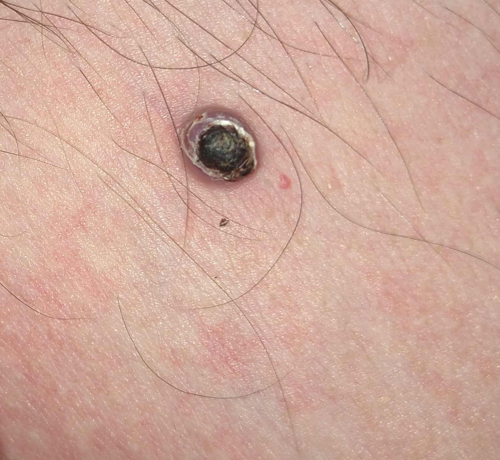 Help is needed. Mole - My, Birthmarks, Question, Dermatology, Longpost