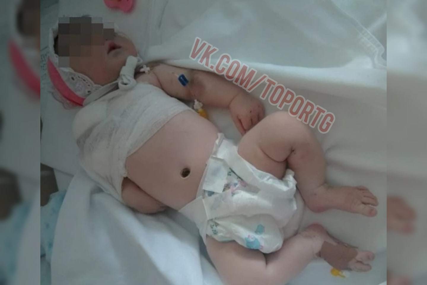 Russia and maternity hospitals - Novosibirsk, Birth of a child, Broken arm, Operation, Without anesthesia, Longpost