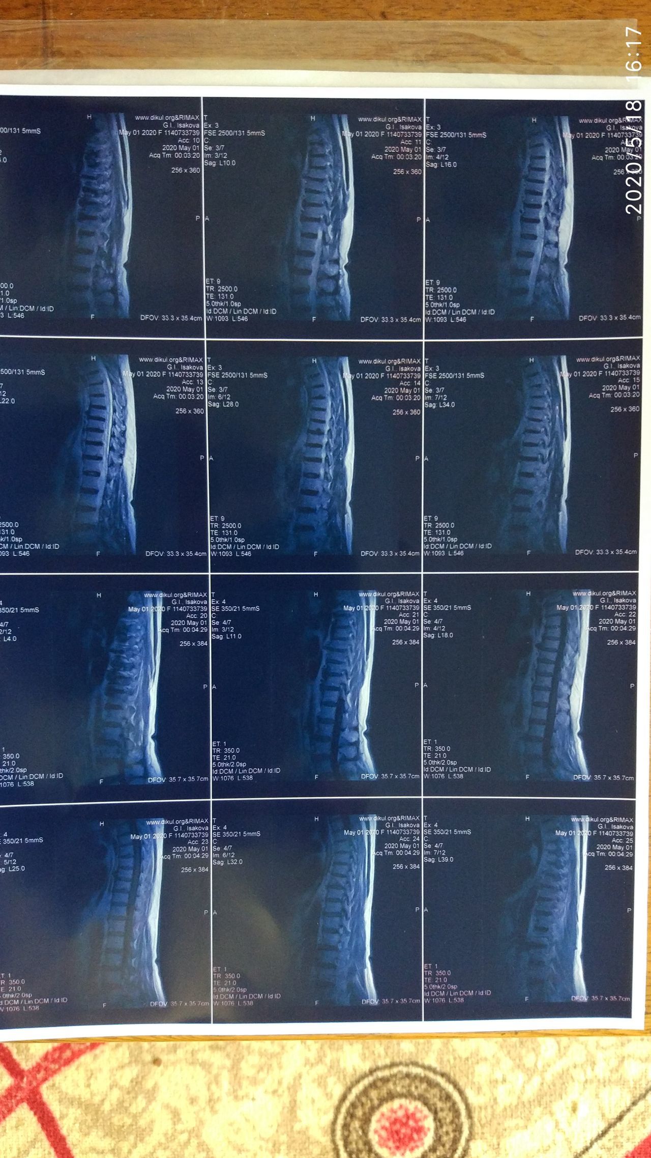 Need help from a neurologist or oncologist - MRI, Legs, Disease, Longpost