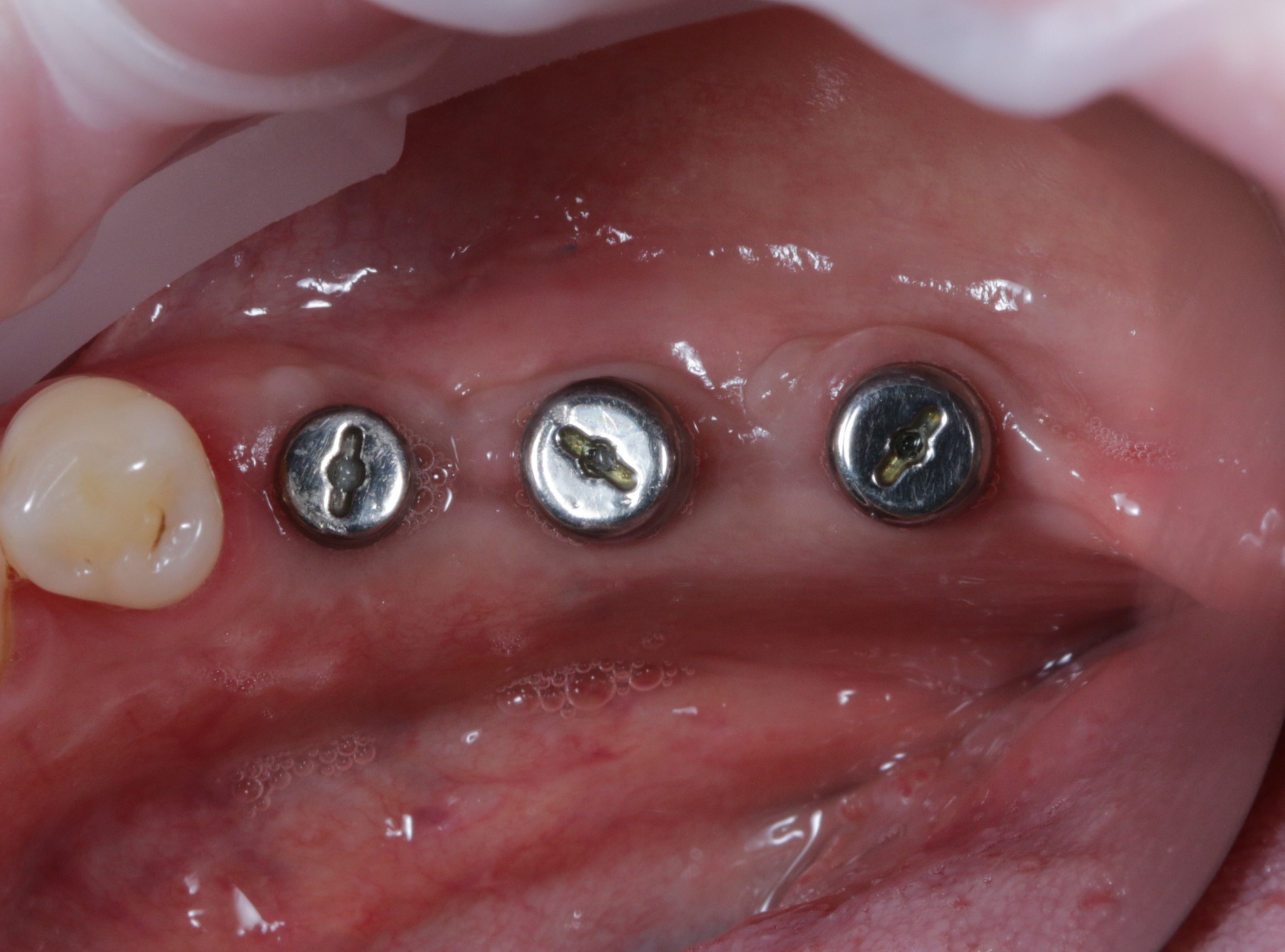 Dentistry: expectation and reality - My, Dentist, Dentistry, Surgeon, Doctors, Teeth, Dental implantation, The medicine, Doctor, Longpost