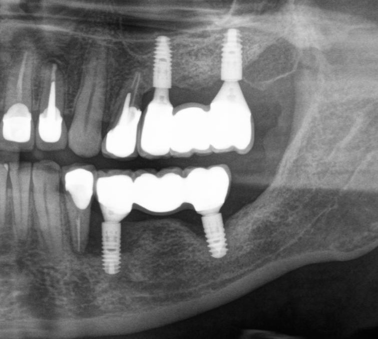 Dentistry: expectation and reality - My, Dentist, Dentistry, Surgeon, Doctors, Teeth, Dental implantation, The medicine, Doctor, Longpost