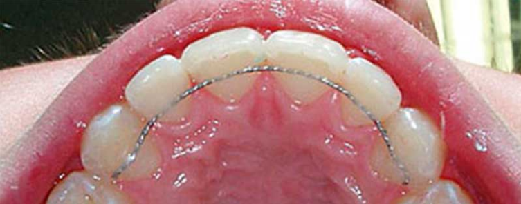 Do braces ruin your teeth? - My, Braces, Dentistry, Orthodontics, Orthodontist, Longpost