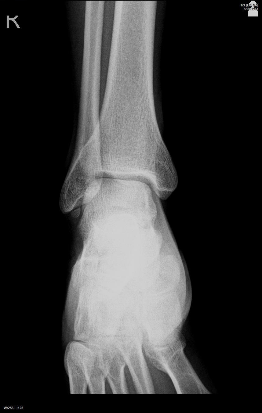 Old apical avulsion of the lateral malleolus - My, Injury, The medicine, Orthopaedist, Advice, Doctor, Longpost