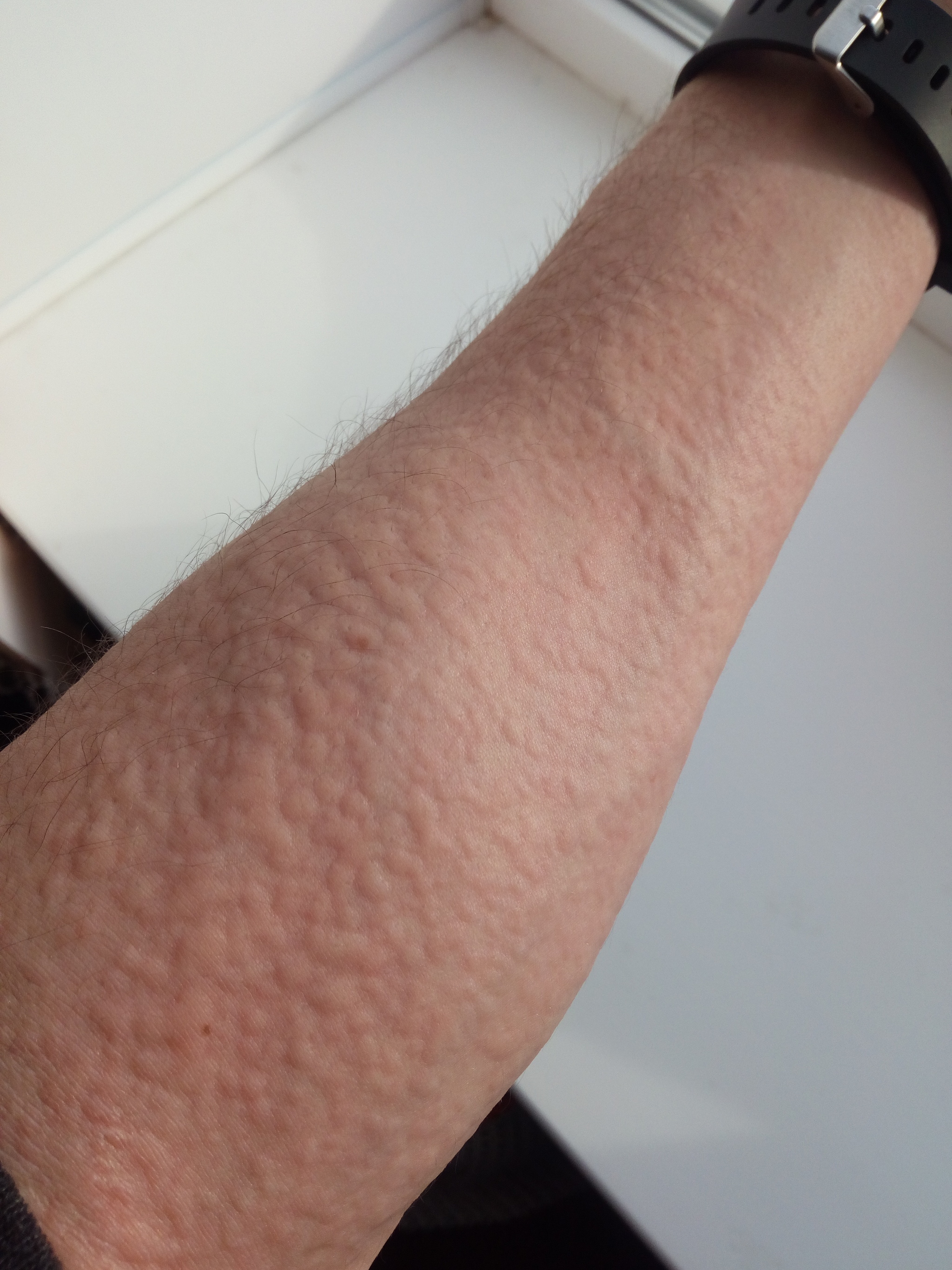 Help is needed - My, Dermatology, Allergies, Allergy, Longpost