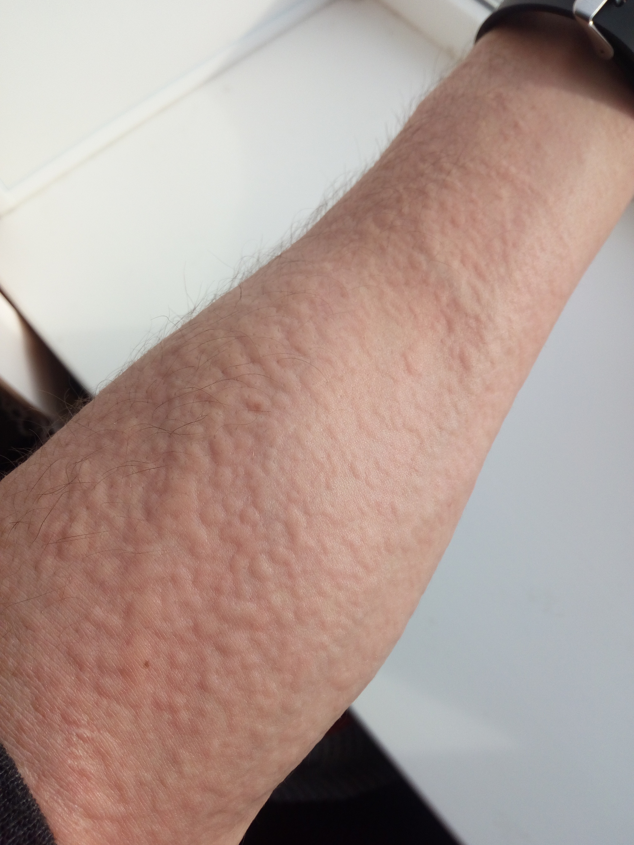 Help is needed - My, Dermatology, Allergies, Allergy, Longpost