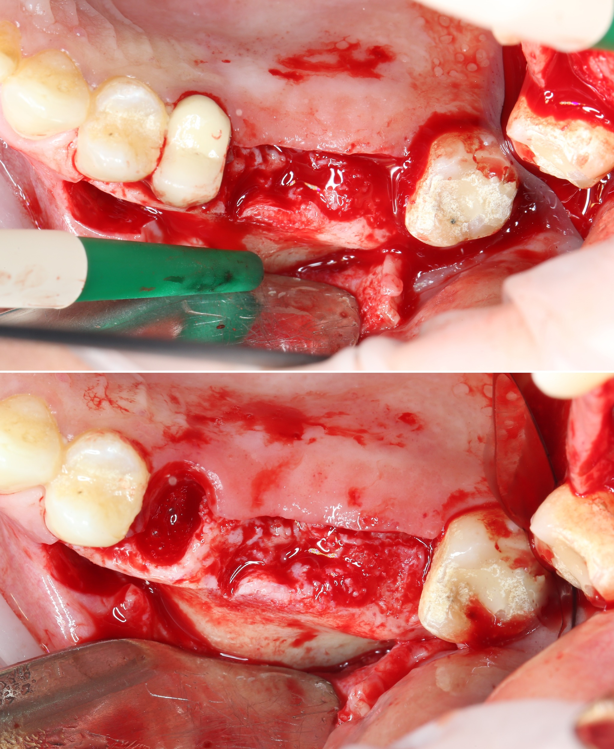 Sinus lift: how is it done? Part I - My, Dentist, Dentistry, Surgery, Implantation, Dental implantation, The medicine, Extraction of teeth, Doctors, Teeth, Doctor, Longpost, Informative