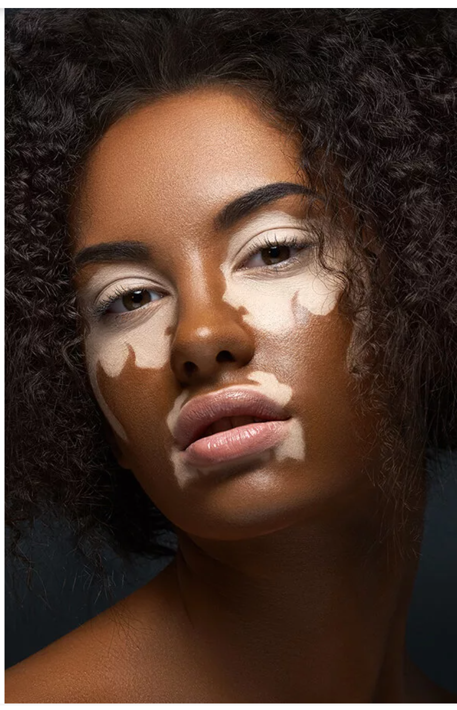 Vitiligo - My, Nature, beauty, Longpost