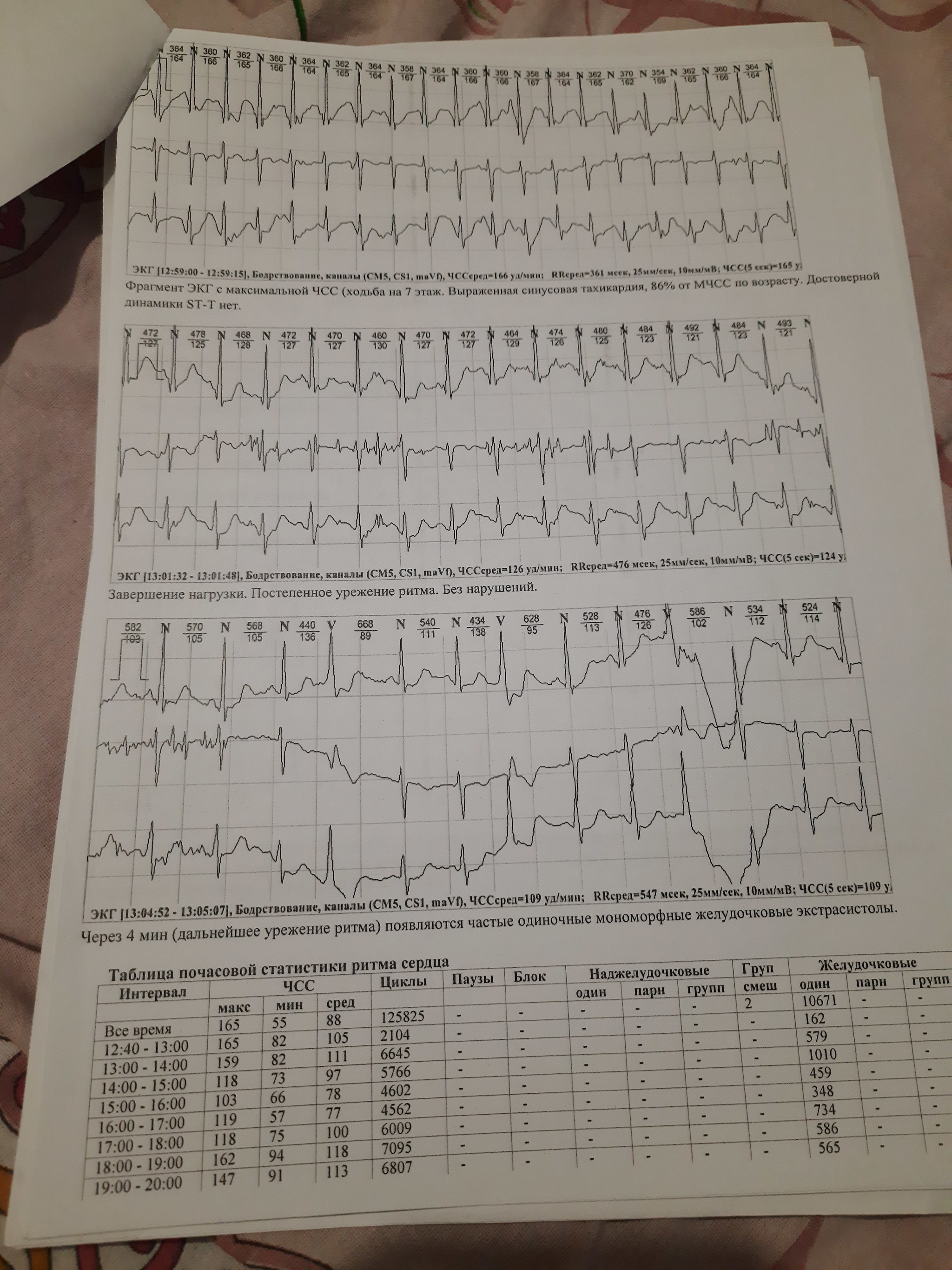 Extrasystoles... How to deal with them? - My, Cardiology, Arrythmia, The medicine, Arrhythmia, No rating, Longpost