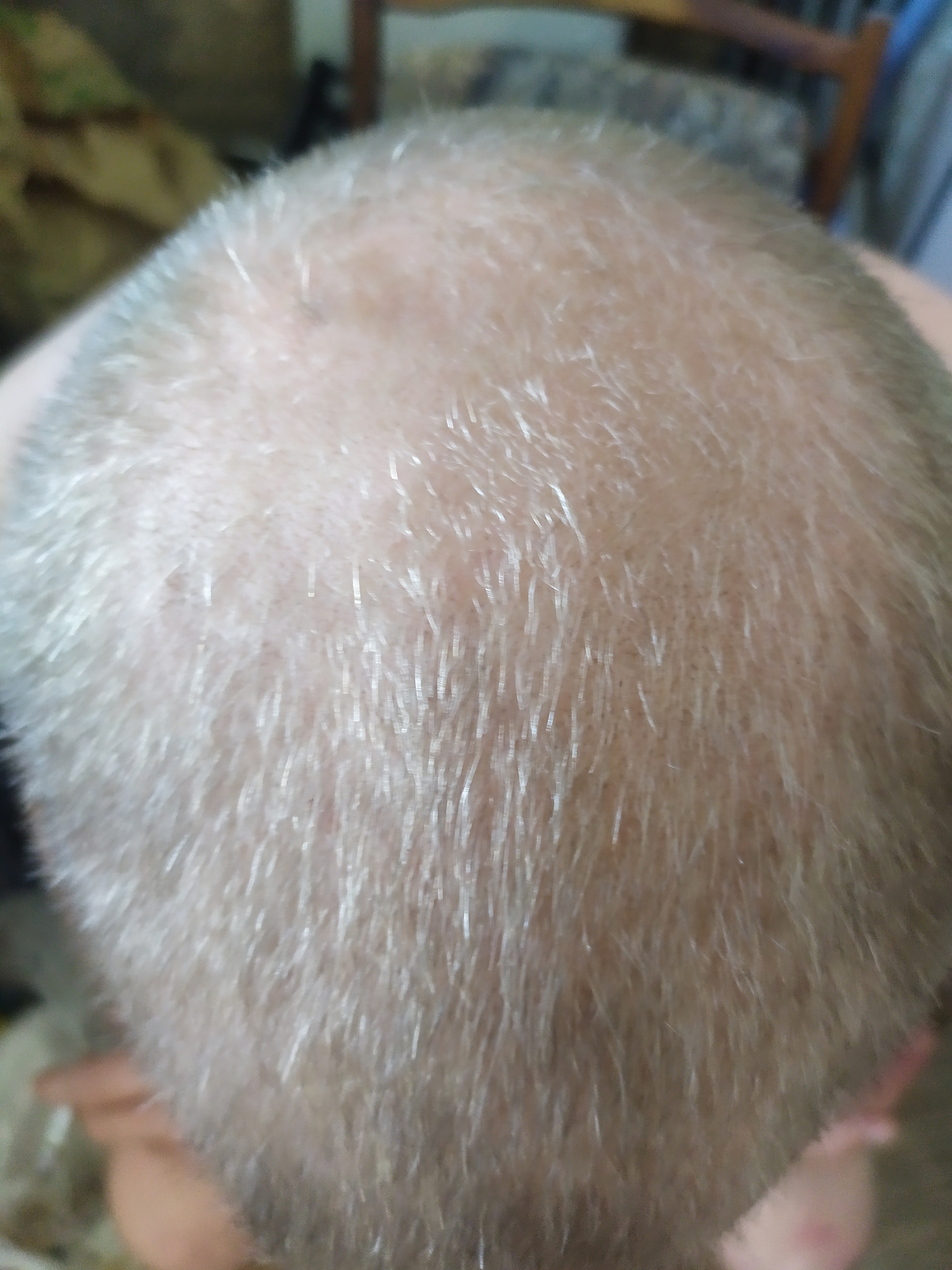 My way to treat baldness - Baldness, Treatment, Positive, Longpost