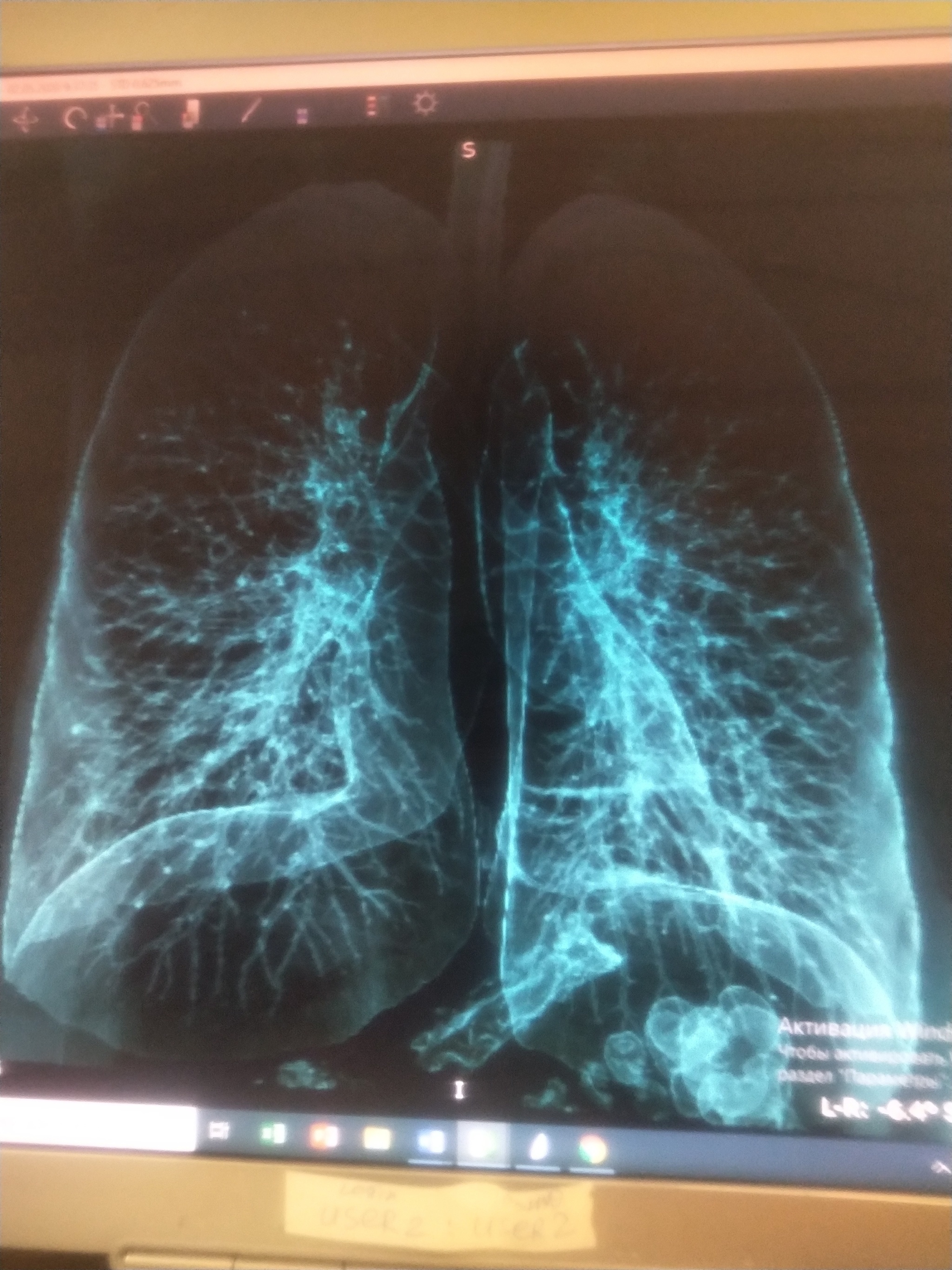 Lungs affected by Covid - My, Coronavirus, Pneumonia, CT, Lungs, Longpost