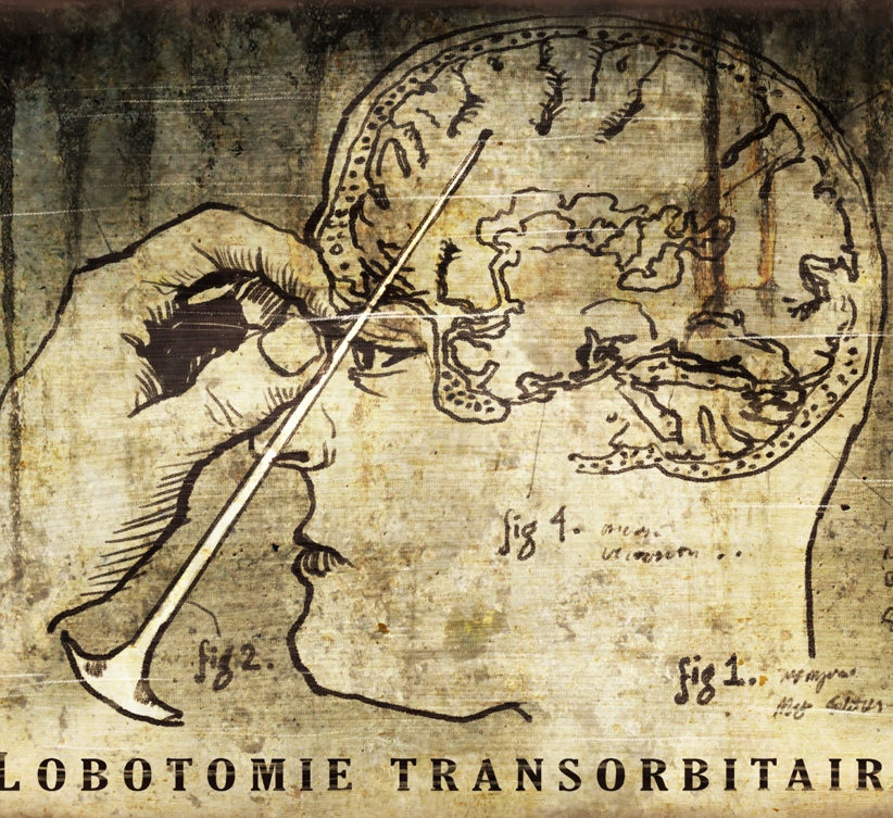 A little about lobotomy in the USA - My, Cat_cat, Story, Lobotomy, The medicine, USA, Longpost